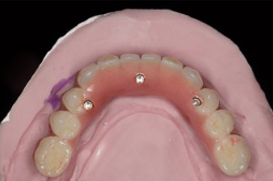 denture over implant clinical case#7