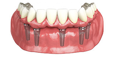 full-arch-dental-implant-teeth