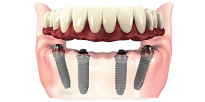 all-on-4-dental implants
