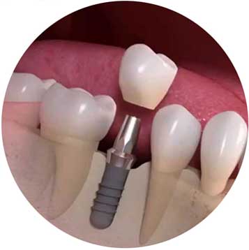 best dental implants in the bronx