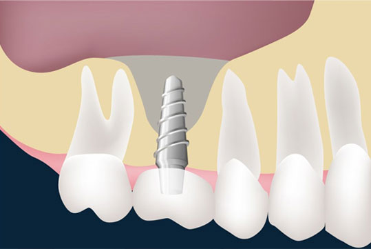 impacted wisdom teeth