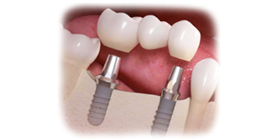 bridge over dental implants
