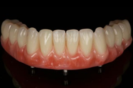 denture over implant clinical case#8