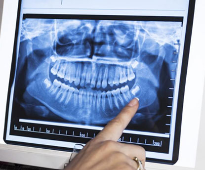 teeth extractions