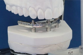 denture over implant clinical case#6