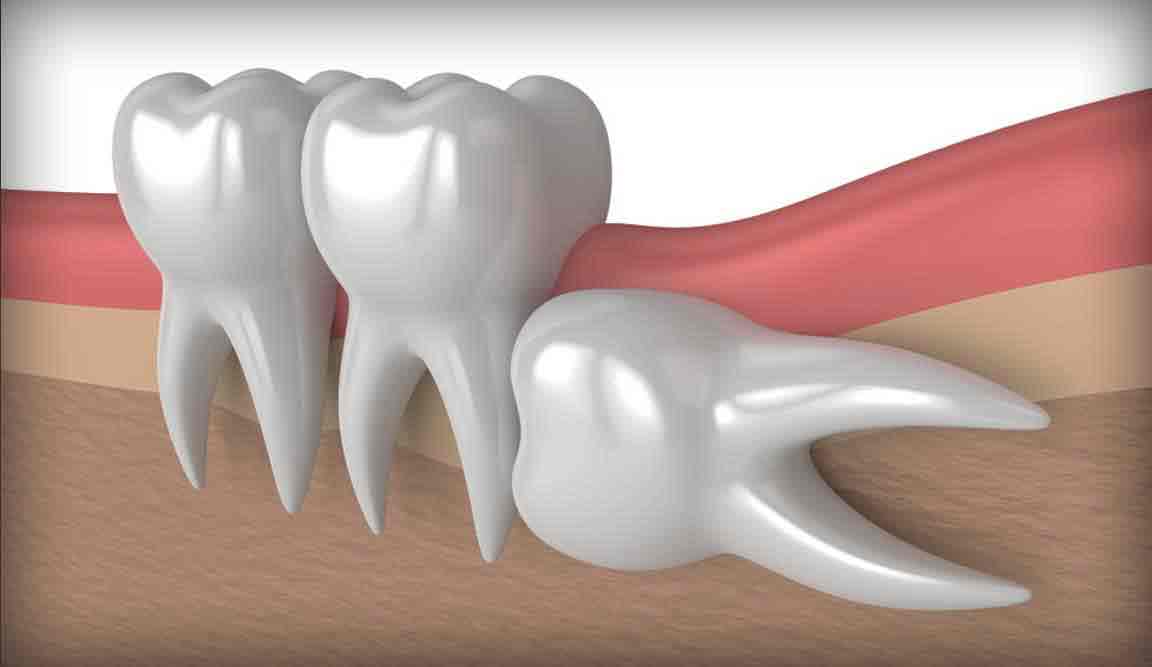 horizontal impacted tooth