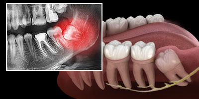 impacted tooth may be close to major nerves