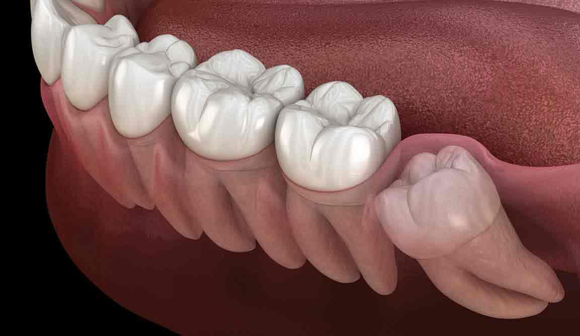 impacted wisdom teeth