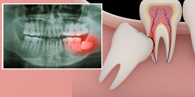 impacted wisdom teeth