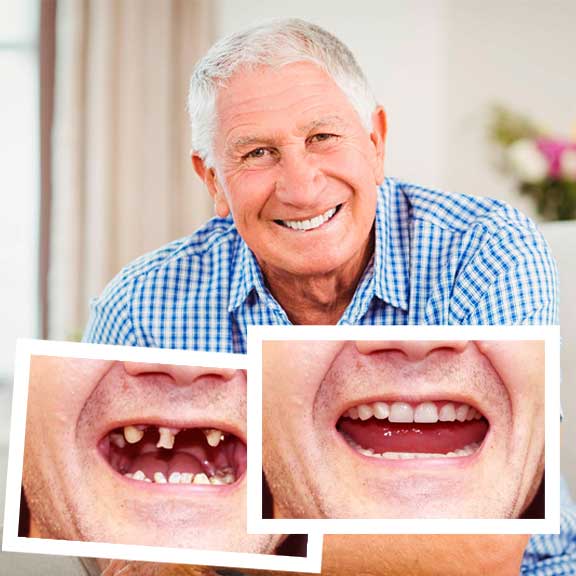 all on 4 dental implants