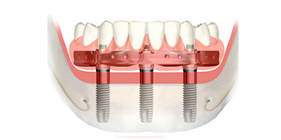 3 implants denture