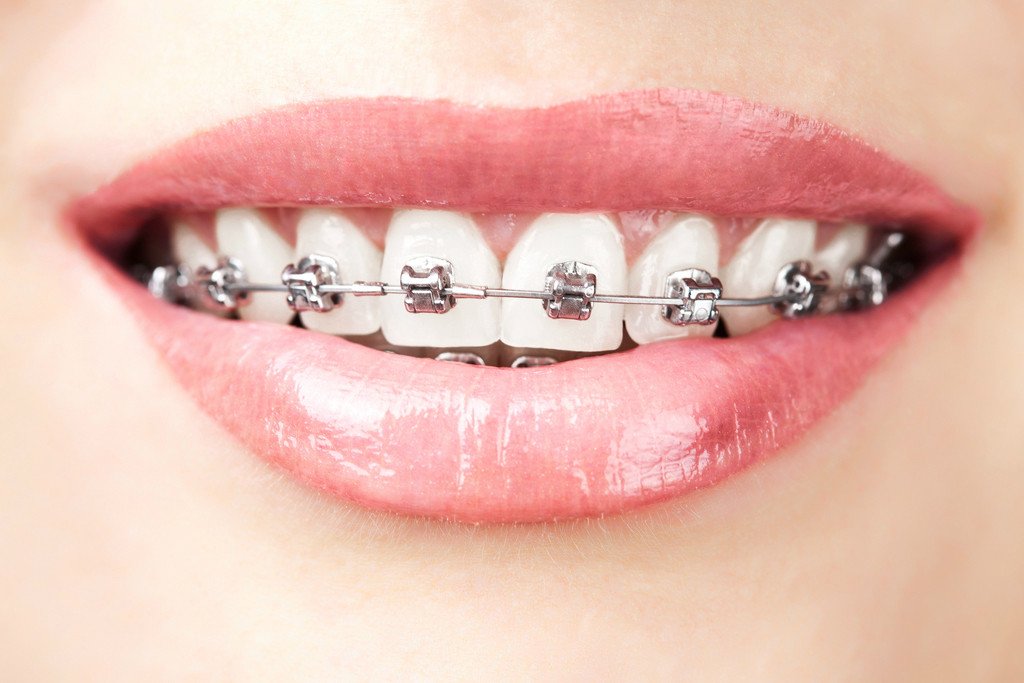 Metal braces